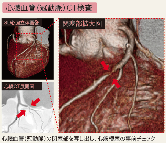 心臓血管CT
